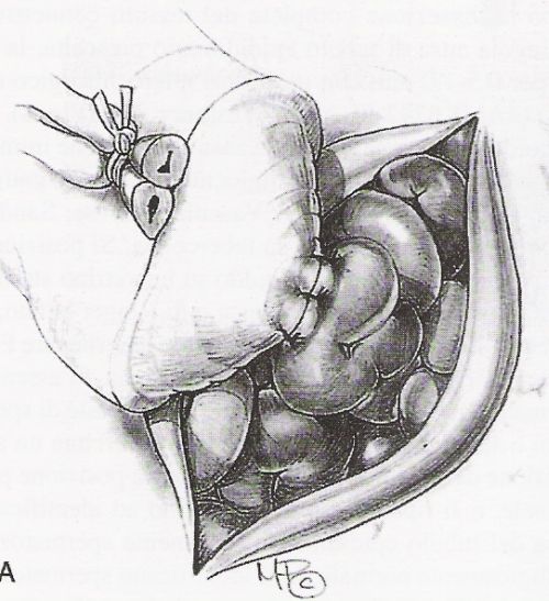 Apertura del tubulo epididimario nella tecnica di Thomas — Ricostruzione delle vie seminali