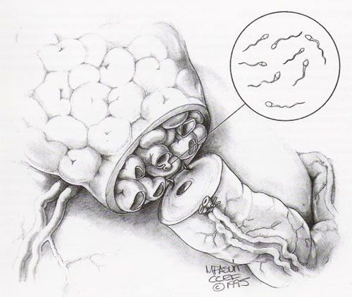Vasoepididimostomia termino-terminale secondo Silber — Ricostruzione delle vie seminali