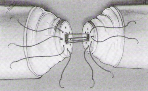Vasovasostomia: sutura dello strato mucoso — Ricostruzione delle vie seminali