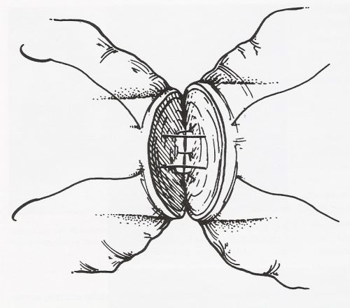 Vasovasostomia: sutura della muscolare interna — Ricostruzione delle vie seminali