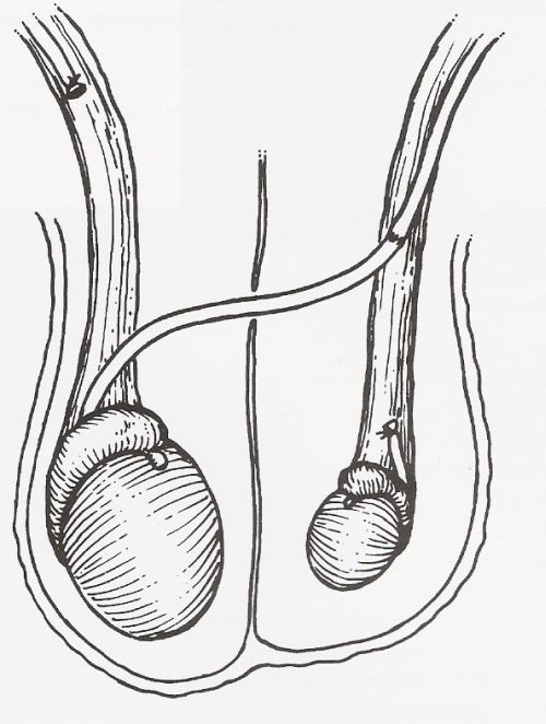 Vasovasostomia crociata — Ricostruzione delle vie seminali