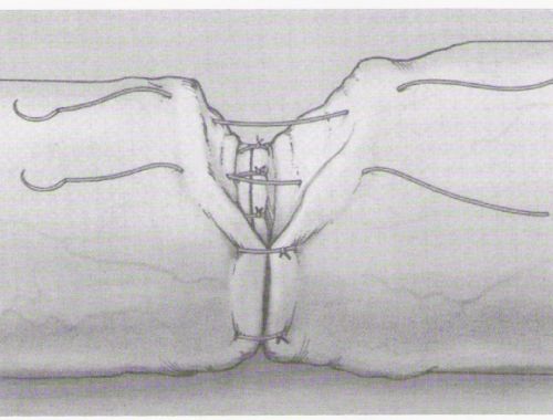 Vasovasostomia: sutura della muscolare esterna e della sierosa — Ricostruzione delle vie seminali