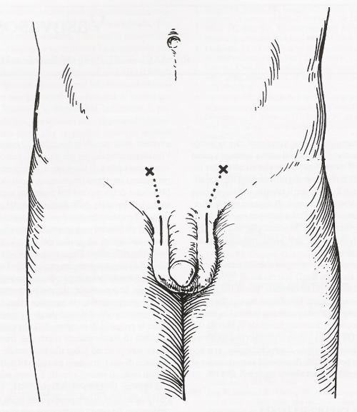 Incisione verticale alta scrotale per la vasovasostomia — Ricostruzione delle vie seminali