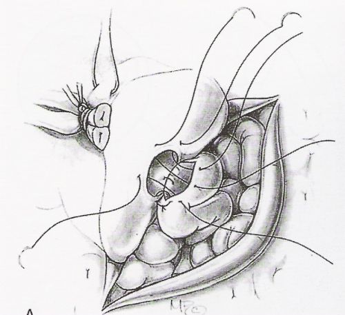 Vasoepididimostomia termino-laterale secondo Thomas — Ricostruzione delle vie seminali