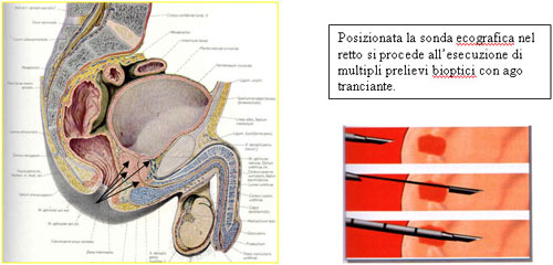 Diagnosi — Terapia del tumore prostatico