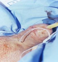 L'intervento di Prostatectomia Radicale Perineale prevede le seguenti fasi chirurgiche — Terapia del tumore prostatico