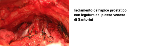 - Isolamento delle vescicole seminali — Terapia del tumore prostatico
