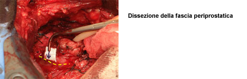 - Isolamento delle vescicole seminali — Terapia del tumore prostatico