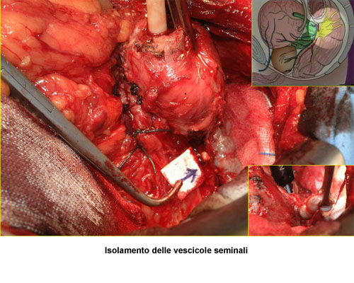 - Isolamento delle vescicole seminali — Terapia del tumore prostatico