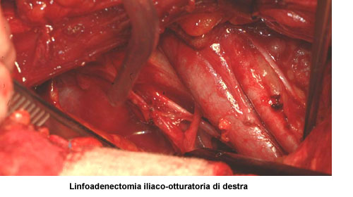 La scelta dell'accesso chirurgico comporta una serie di considerazioni — Terapia del tumore prostatico