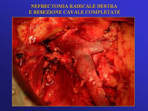 Terapia del tumore del rene — figura 27