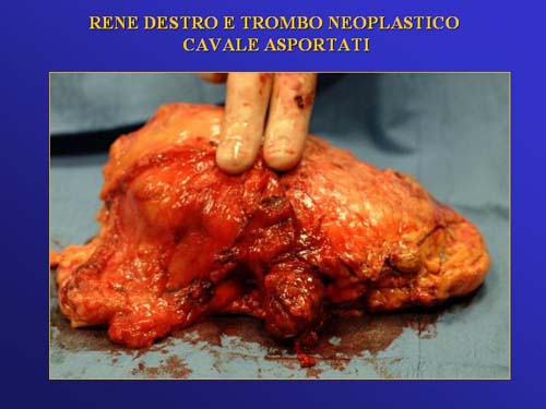 Terapia del tumore del rene — figura 28