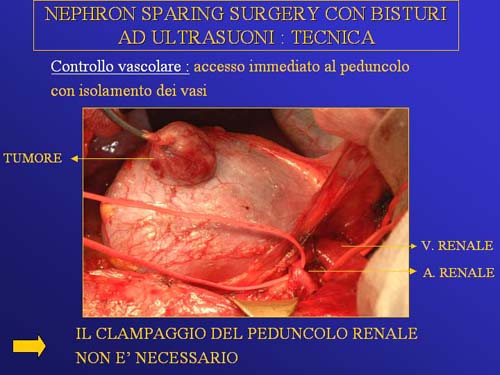 Terapia del tumore del rene — figura 39