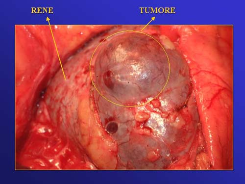 Terapia del tumore del rene — figura 40