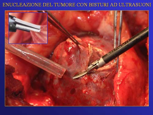 Terapia del tumore del rene — figura 42