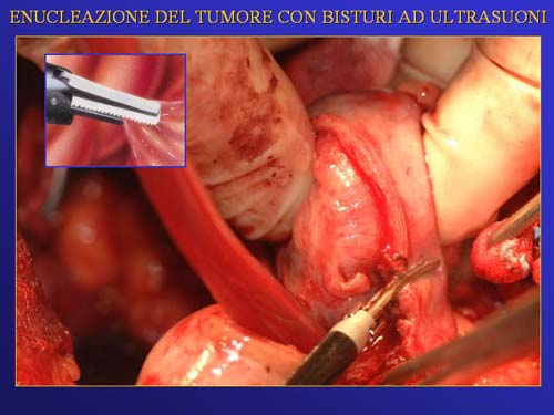 Chirurgia nefron sparing mininvasiva — Terapia del tumore del rene