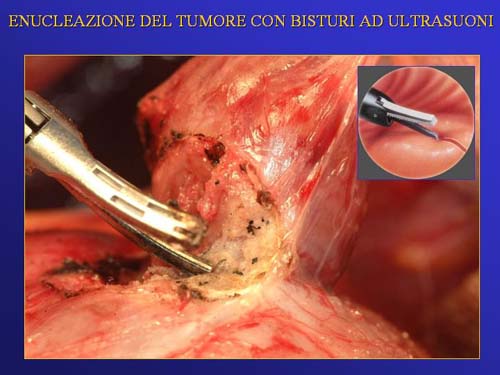 Chirurgia nefron sparing mininvasiva — Terapia del tumore del rene