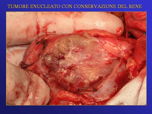 Chirurgia nefron sparing mininvasiva — Terapia del tumore del rene