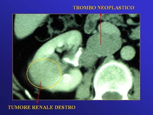 Neferctomia radicale — Terapia del tumore del rene