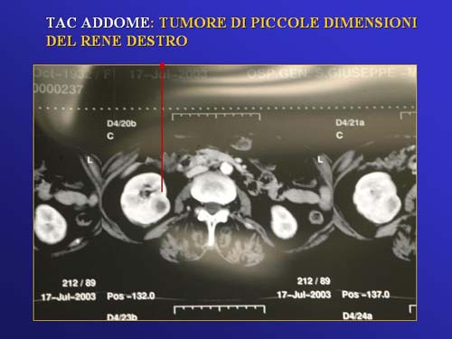 Terapia del tumore del rene — figura 47