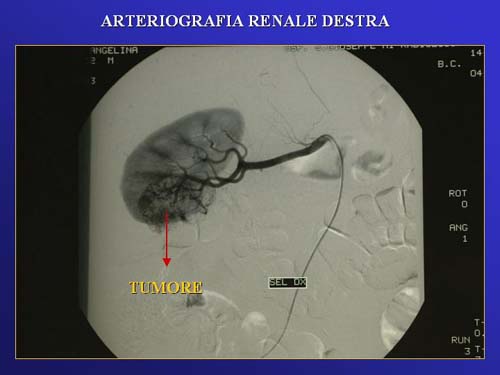 Chirurgia nefron sparing mininvasiva — Terapia del tumore del rene
