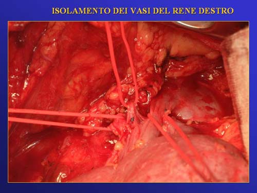 Chirurgia nefron sparing mininvasiva — Terapia del tumore del rene