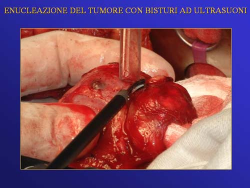 Chirurgia nefron sparing mininvasiva — Terapia del tumore del rene