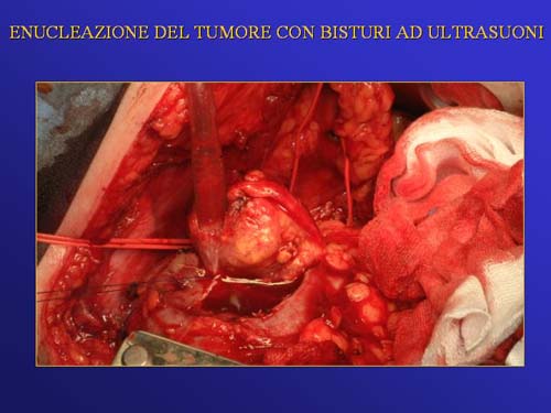 Chirurgia nefron sparing mininvasiva — Terapia del tumore del rene