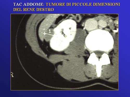 Chirurgia nefron sparing mininvasiva — Terapia del tumore del rene