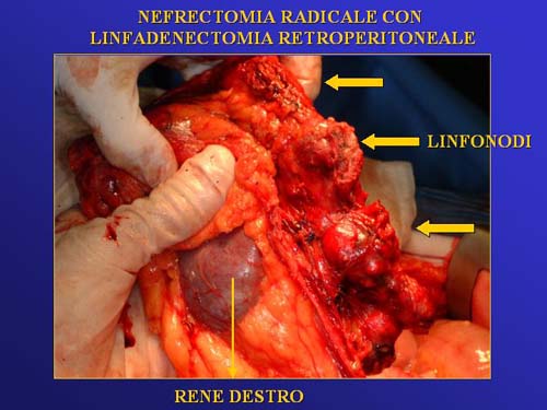 Neferctomia radicale — Terapia del tumore del rene