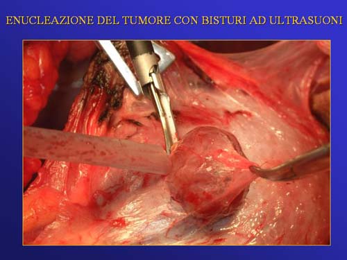 Chirurgia nefron sparing mininvasiva — Terapia del tumore del rene