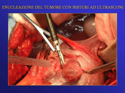 Chirurgia nefron sparing mininvasiva — Terapia del tumore del rene