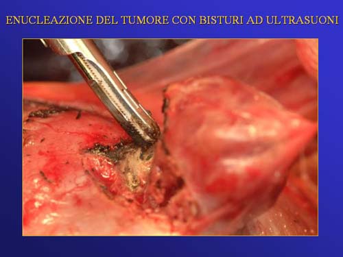 Terapia del tumore del rene — figura 59