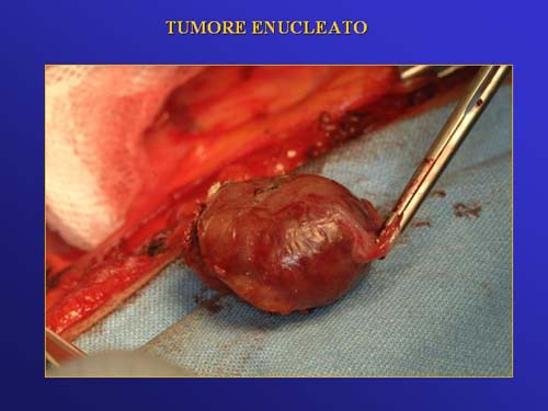 Terapia del tumore del rene — figura 60