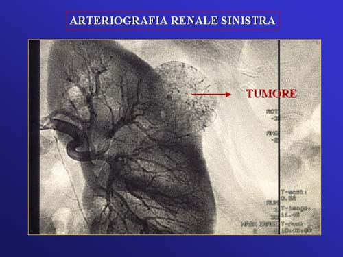 Terapia del tumore del rene — figura 62