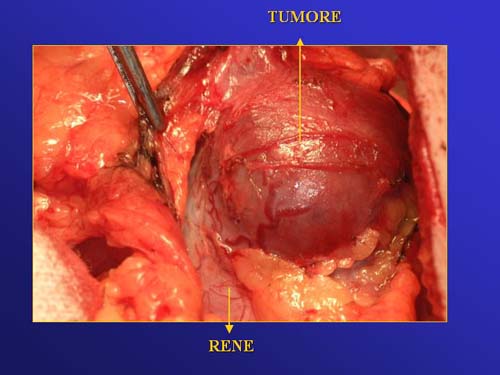 Terapia del tumore del rene — figura 64