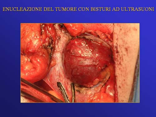 Terapia del tumore del rene — figura 65