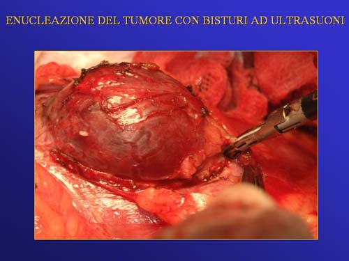 Terapia del tumore del rene — figura 66