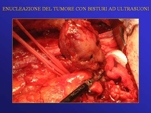 Terapia del tumore del rene — figura 67