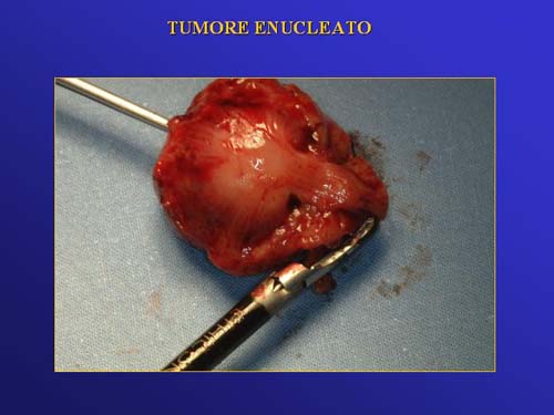 Chirurgia nefron sparing mininvasiva — Terapia del tumore del rene