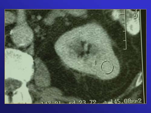 Terapia del tumore del rene — figura 70