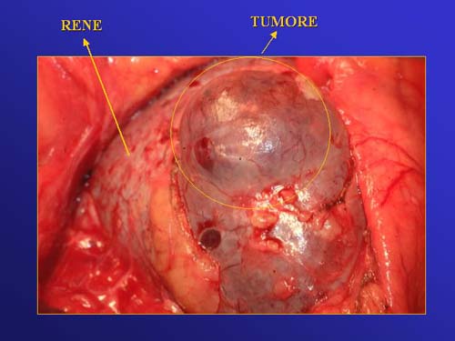 Terapia del tumore del rene — figura 71