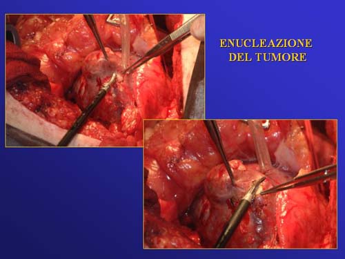 Terapia del tumore del rene — figura 72