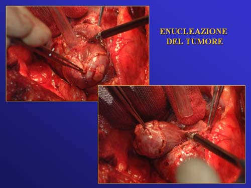 Terapia del tumore del rene — figura 74