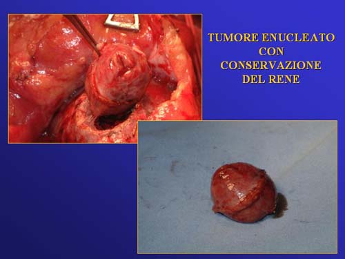 Terapia del tumore del rene — figura 75