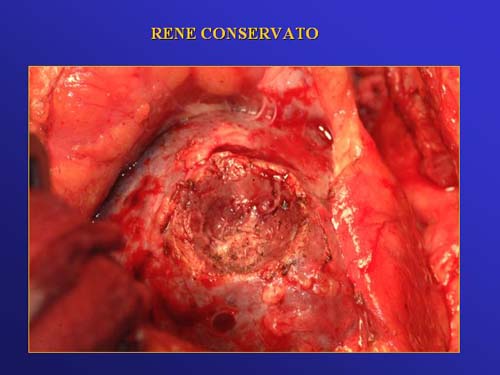 Terapia del tumore del rene — figura 76