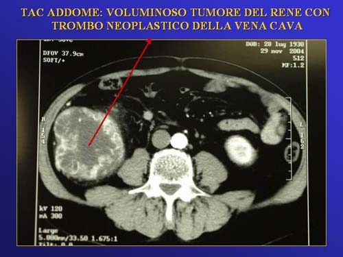 Terapia del tumore del rene — figura 23