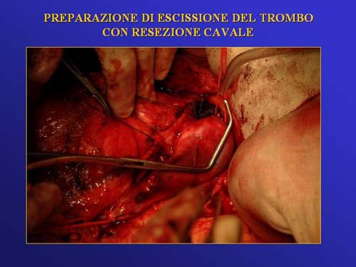 Terapia del tumore del rene — figura 24