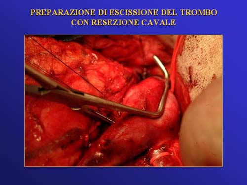 Terapia del tumore del rene — figura 25