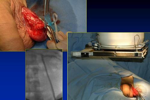 Quali esami sono necessari per diagnosticare l’infertilità maschile ? — Infertilità